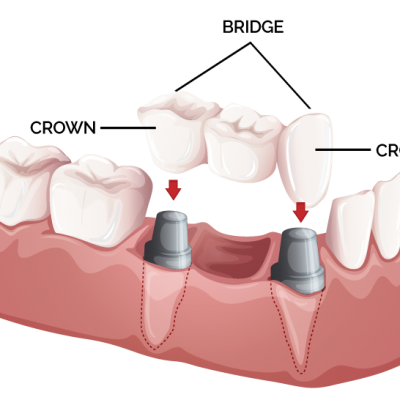 dental-bridge-crowns-santa-ana